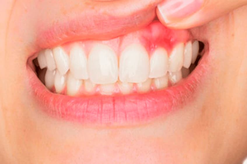 Gum Disease Treatment for