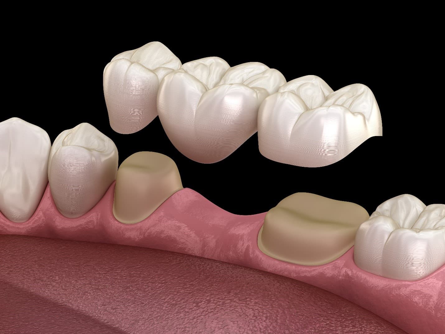 Dental Bridge After Extraction