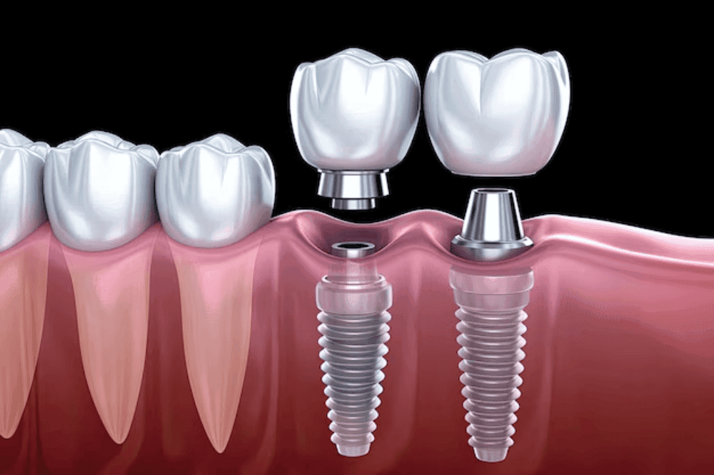 Dental Implant After Extraction