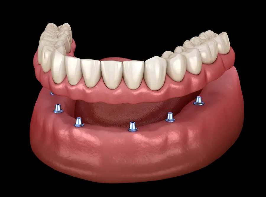 Partial Denture After Extraction